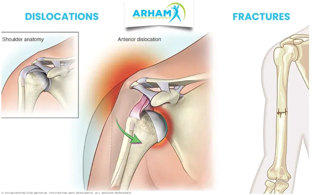 Accidental Fractures