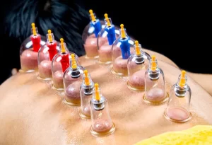 Cupping Therapy Image | Arham Physiotherapy & Rehabilitation Centre | Nikol | Ahmedabad | Gujarat