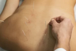 Dry Needling Therapy Image | Arham Physiotherapy & Rehabilitation Centre | Nikol | Ahmedabad | Gujarat