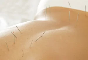 Dry Needling Therapy Image | Arham Physiotherapy & Rehabilitation Centre | Nikol | Ahmedabad | Gujarat